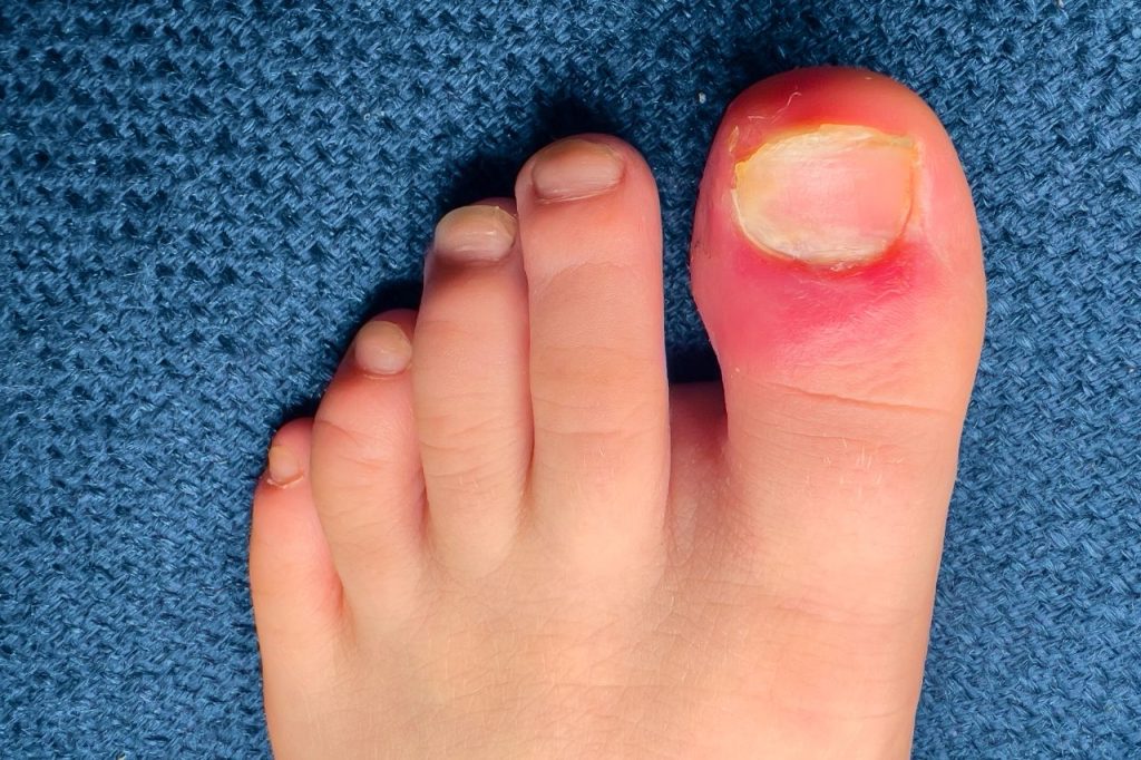 Care for ingrown toenails